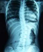 Radiografía de una columna vertebral con escoliosis